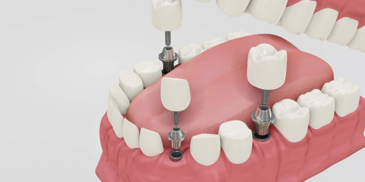 http://lakeshoredentistry.ca/wp-content/uploads/2022/07/dental_implants1-1280x640.jpeg