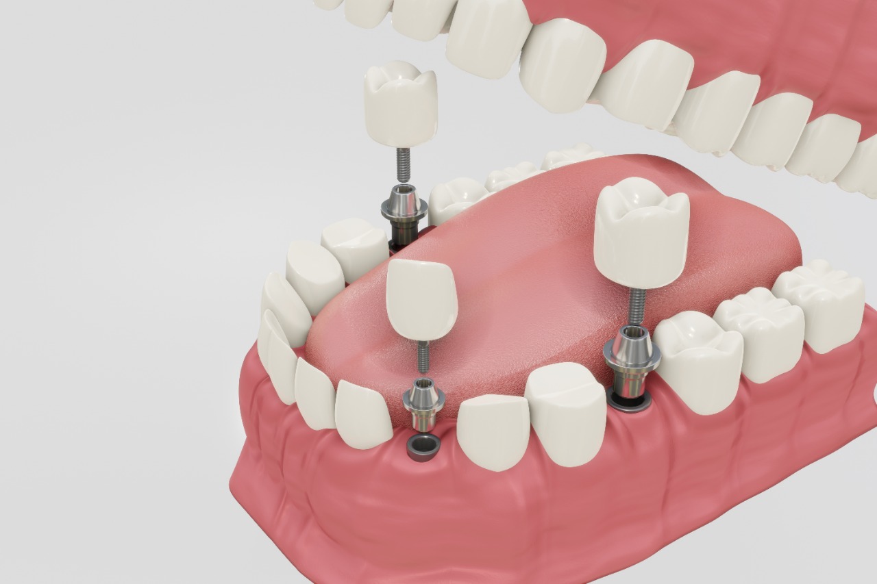 Which Type Of Dental Implant Is Best For You?