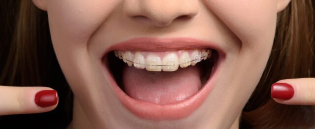 Teeth Braces Port Credit Mississauga